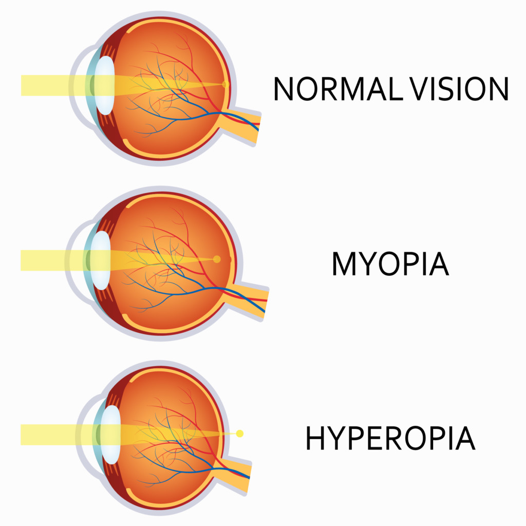 astigmatism-and-its-importance-in-eye-surgery-loden